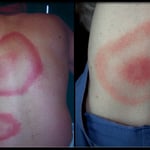 Lyme Disease