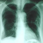 Asbestos fibers in lungs