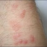 bites