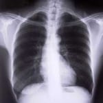 mesothelioma