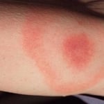 Tick Bite causing lyme