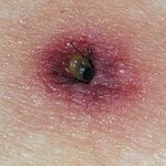 Tick Bite